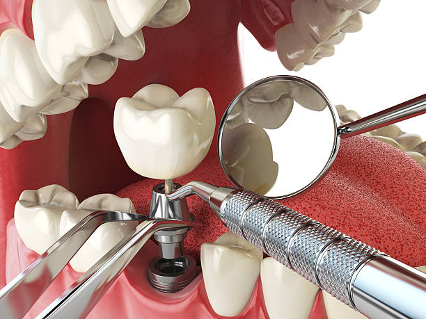 Best Emergency Wisdom Teeth Removal in Hunter, TN